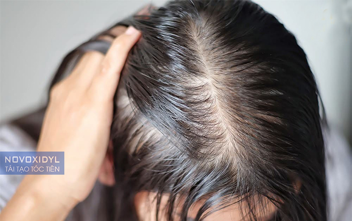 Cách giảm rụng tóc do hội chứng buồng trứng đa nang (PCOS)
