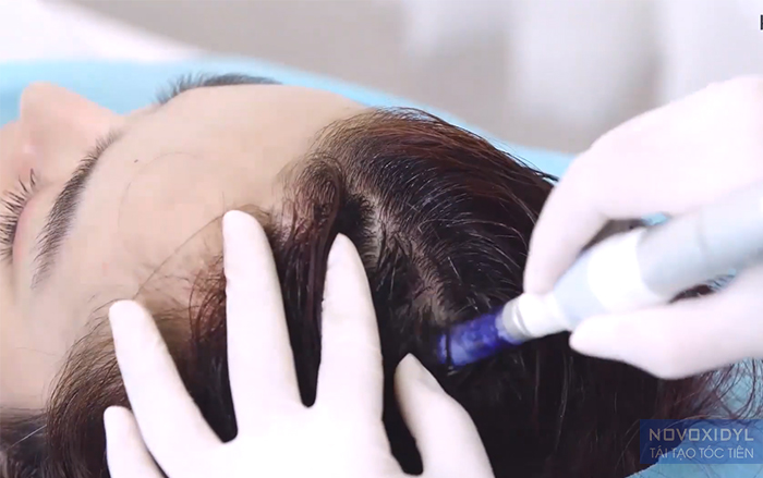 Cấy tóc tế bào gốc có thể giúp hỗ trợ mọc lại tóc